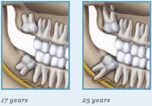 Wisdom teeth